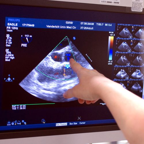 Kardiológiai vizsgálat szívultrahanggal, a MyDoctor Egészségközpontban Dr. Pál Tamás főorvos, a kardiológiai diagnosztika szakértője végzi