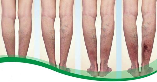 Vedd komolyan: a visszeresség végzetessé is válhat